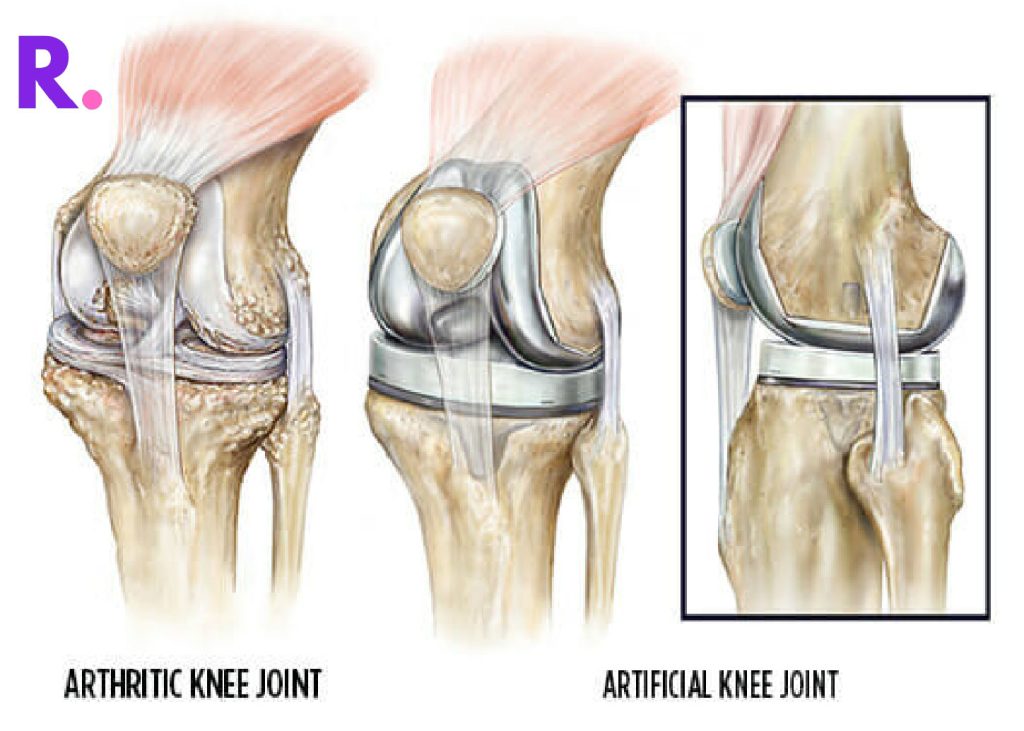 Top 5 Mistakes after Knee Replacement
